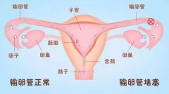 惨痛经历告诉你：发现输卵管堵塞该怎么办