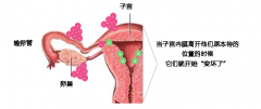 子宫内膜异位症如何治疗